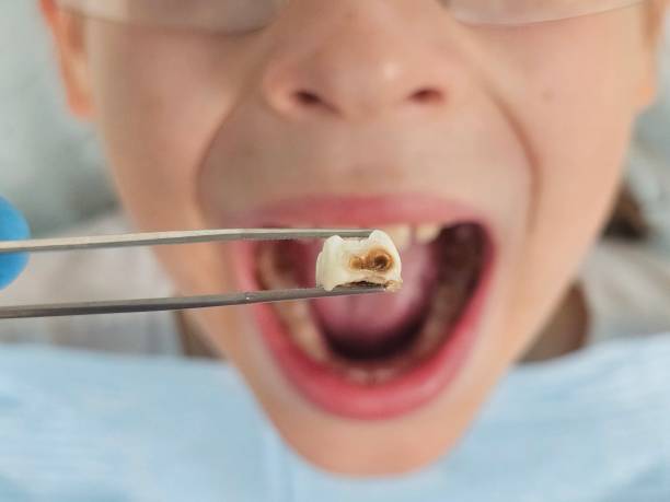 Best Root Canal Emergency Dentist  in Amherst, OH